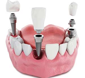 Implant Supported Dentures