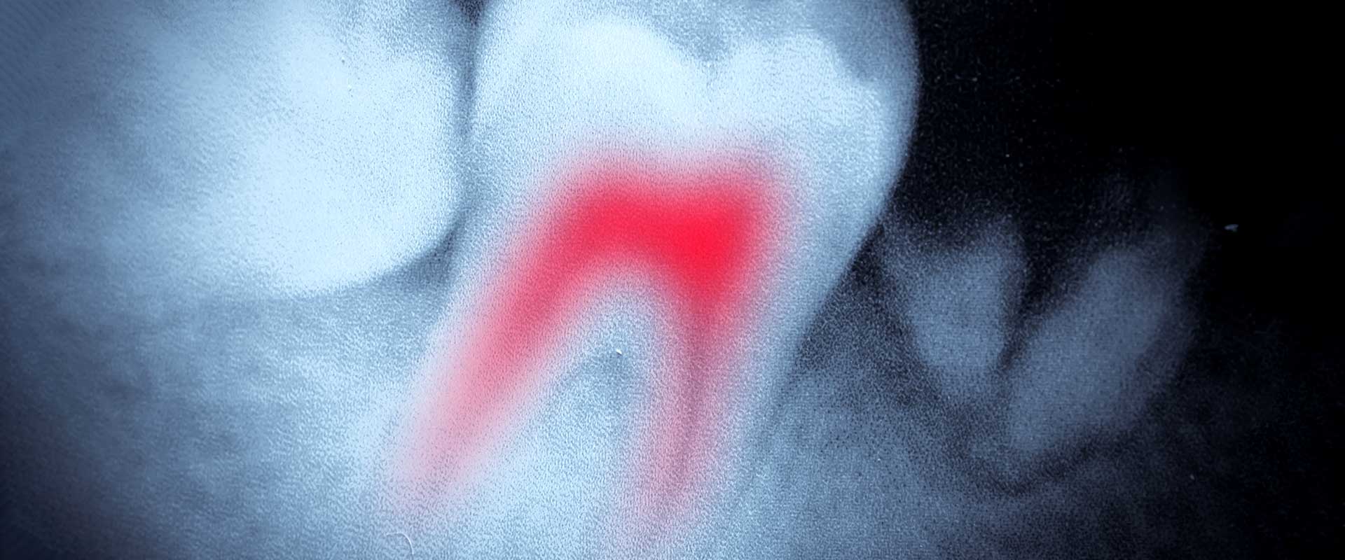 Oakridge Crossing Dental | SW Calgary Dentist | Root Canal Therapy in SW Calgary