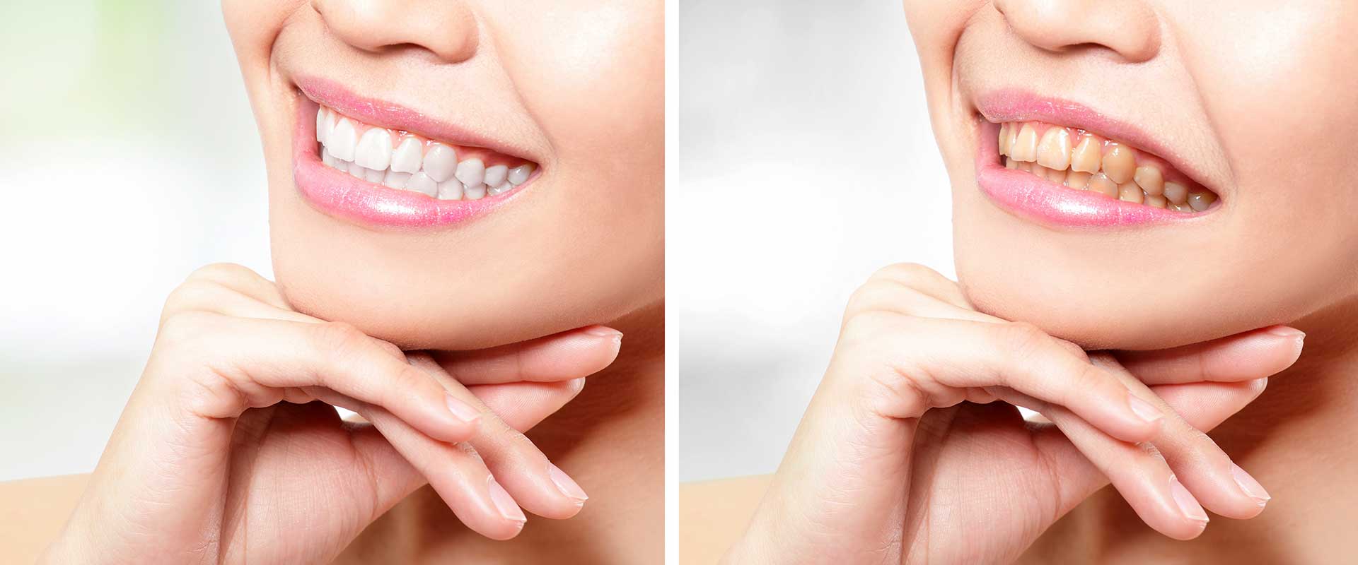 Oakridge Crossing Dental | SW Calgary Dentist | Teeth Whitening in Calgary