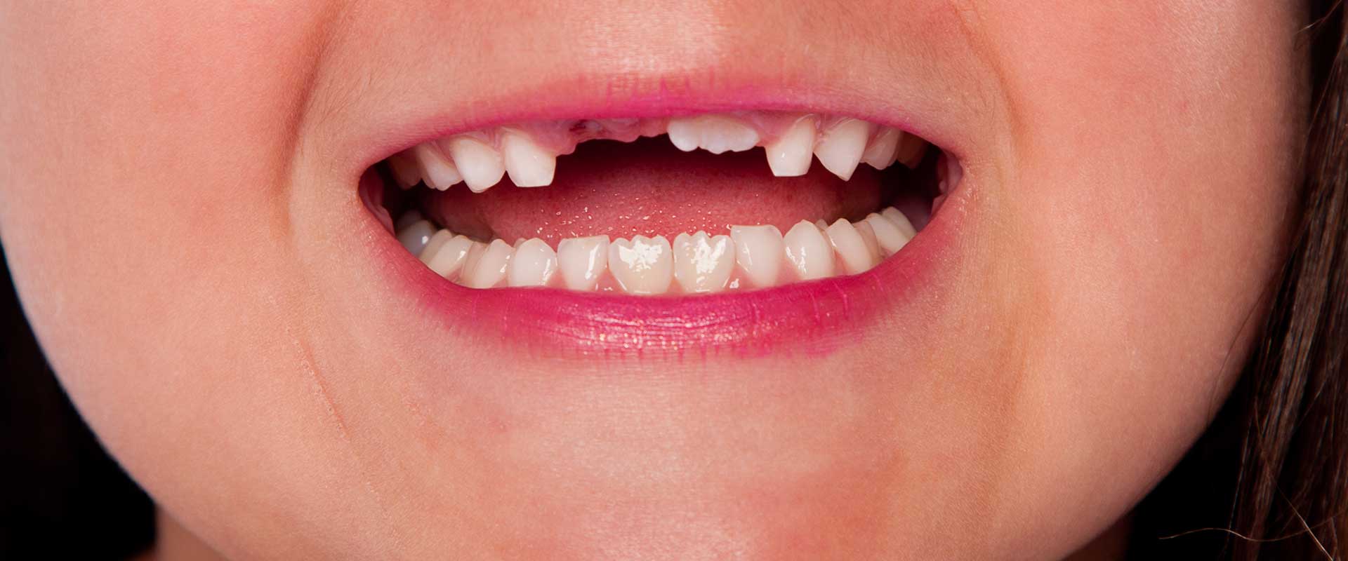 Oakridge Crossing Dental | SW Calgary Dentist | Tooth Extractions Calgary