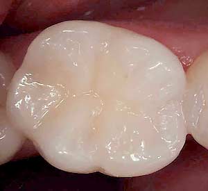 White Fillings